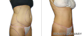 Liposuction Before And After Houston TX
