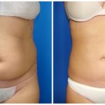 Female Liposuction Before & After Patient #192