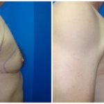 Male Liposuction Before & After Patient #280