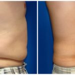 Male Liposuction Before & After Patient #282