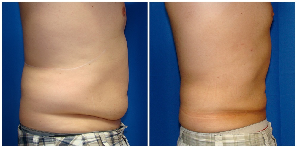 Male Liposuction Before & After Patient #282