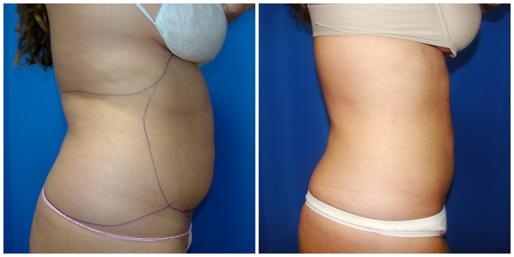 Female Liposuction Before & After Patient #210