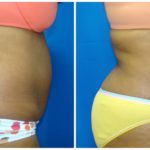 Female Liposuction Before & After Patient #214