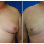 Male Liposuction Before & After Patient #284