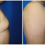 Male Liposuction Before & After Patient #286