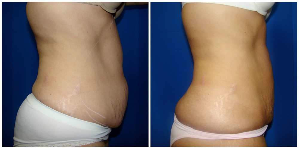 Female Liposuction Before & After Patient #220