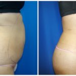 Female Liposuction Before & After Patient #222