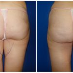 Female Liposuction Before & After Patient #224