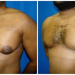Male Liposuction Before & After Patient #288