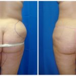 Female Liposuction Before & After Patient #230
