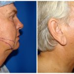 Male Liposuction Before & After Patient #290