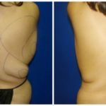 Female Liposuction Before & After Patient #232