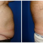 Male Liposuction Before & After Patient #292