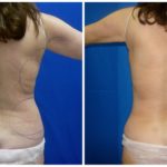 Female Liposuction Before & After Patient #194
