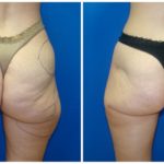 Female Liposuction Before & After Patient #234