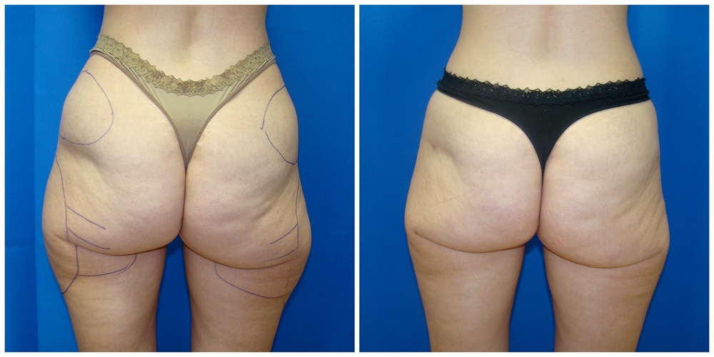 Female Liposuction Before & After Patient #234