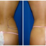 Female Liposuction Before & After Patient #236