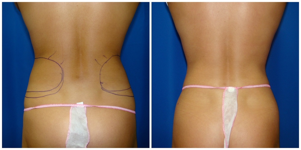 Female Liposuction Before & After Patient #236