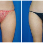 Female Liposuction Before & After Patient #238