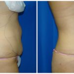 Female Liposuction Before & After Patient #241