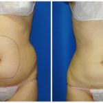 Female Liposuction Before & After Patient #243