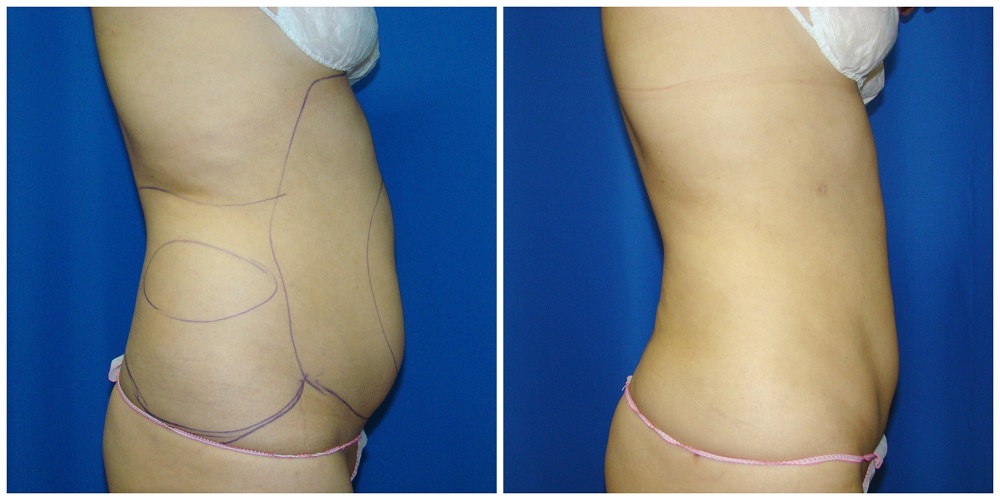 Female Liposuction Before & After Patient #243