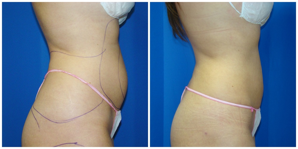 Female Liposuction Before & After Patient #246