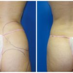 Female Liposuction Before & After Patient #246