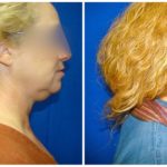 Female Liposuction Before & After Patient #196