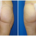 Female Liposuction Before & After Patient #249