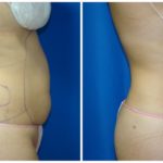 Female Liposuction Before & After Patient #253