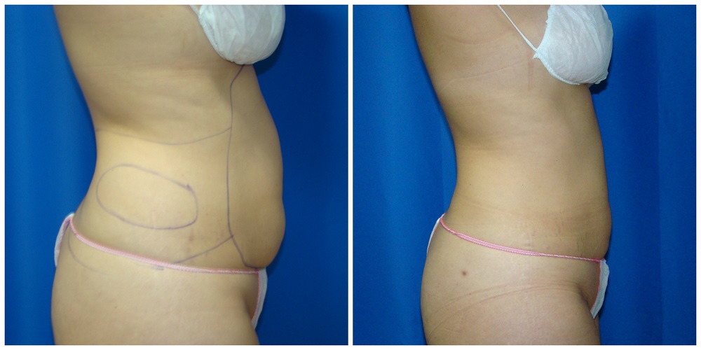 Female Liposuction Before & After Patient #253