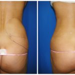 Female Liposuction Before & After Patient #256