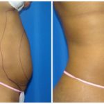 Female Liposuction Before & After Patient #258