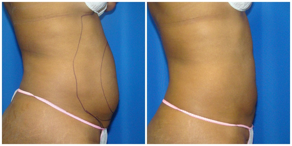 Female Liposuction Before & After Patient #258