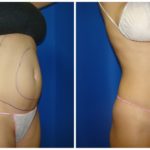 Female Liposuction Before & After Patient #263