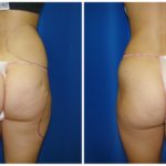 Female Liposuction Before & After Patient #263