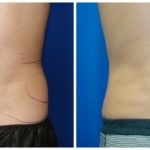 Male Liposuction Before & After Patient #278