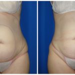 Female Liposuction Before & After Patient #266