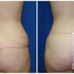 Female Liposuction Before & After Patient #266