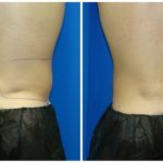 Male Liposuction Before & After Patient #294