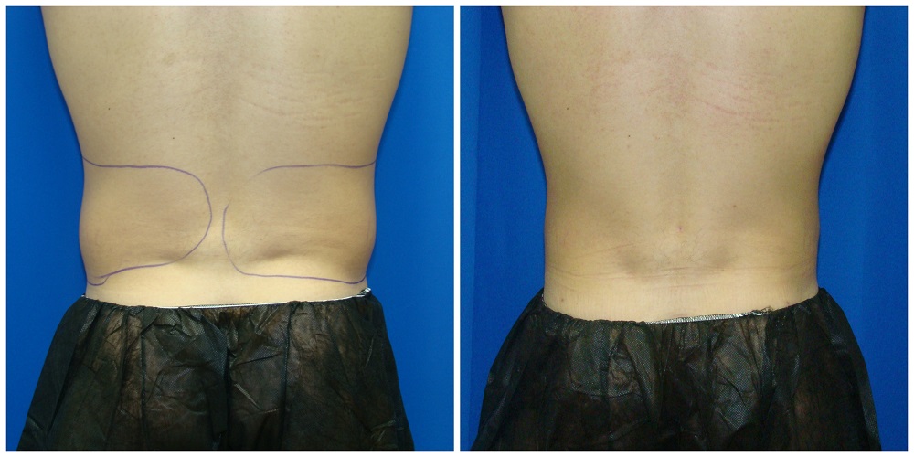 Male Liposuction Before & After Patient #294