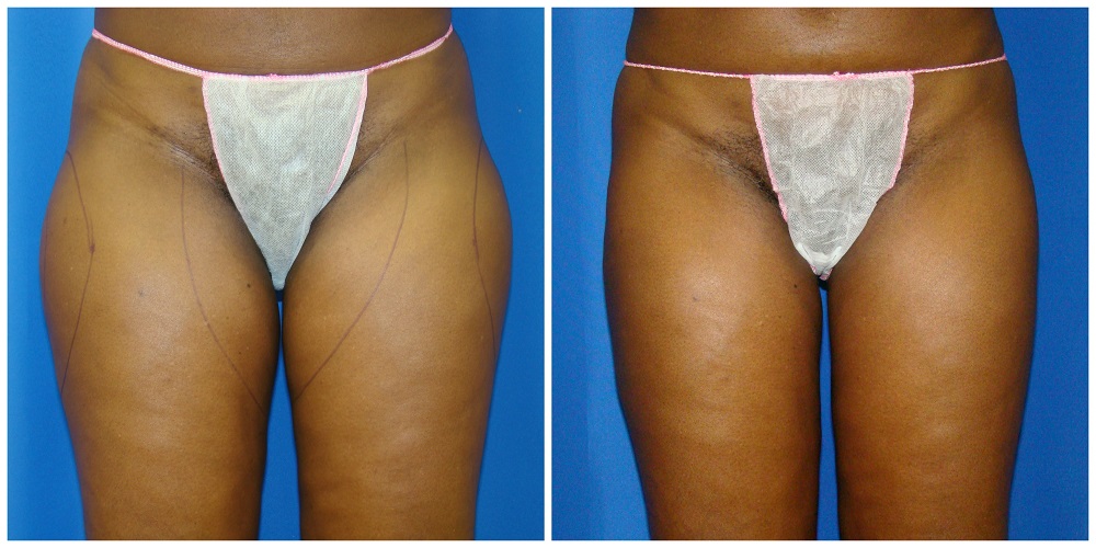 Female Liposuction Before & After Patient #270