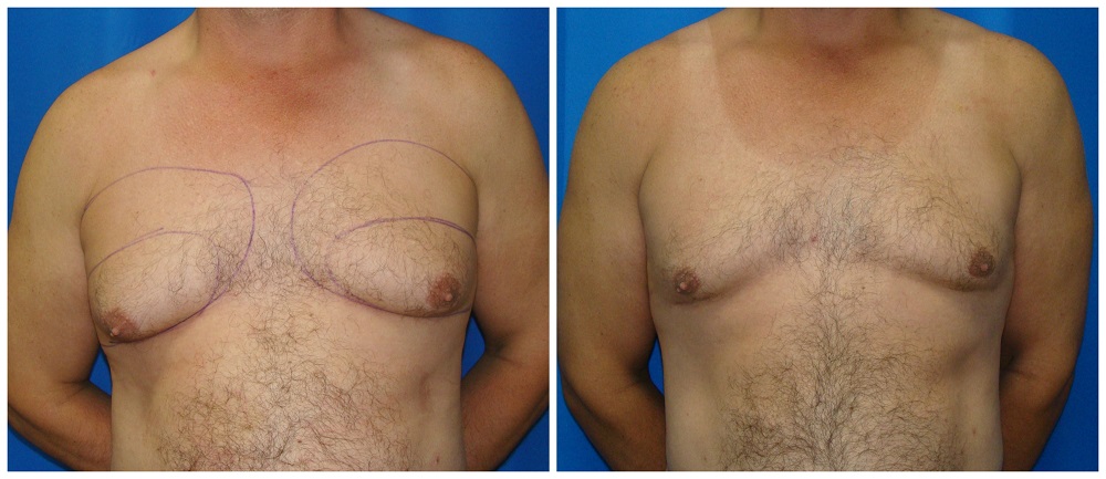 Male Liposuction Before & After Patient #297