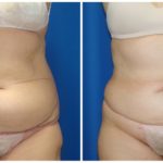 Female Liposuction Before & After Patient #272