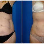 Female Liposuction Before & After Patient #198