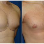 Male Liposuction Before & After Patient #300