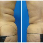 Female Liposuction Before & After Patient #274