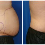 Male Liposuction Before & After Patient #302