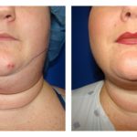 Female Liposuction Before & After Patient #200